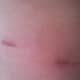 Drain and laparoscopic scars on back