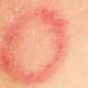 ringworm-images-causes-symptoms-treatment