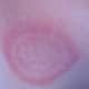 ringworm-images-causes-symptoms-treatment