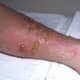 poison-ivy-rash-heals-more-with-a-day-at-the-swimming-pool