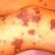 meningitis-symptoms-treatment-causes-rash-pictures