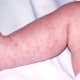 meningitis-symptoms-treatment-causes-rash-pictures