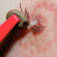 Tick Bite