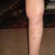 Leg Bruising That Is Associated With Kidney Disease