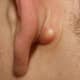 sebaceous-cyst-pictures-symptoms-removal-treatment-causes