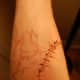 Right arm, one day after excision.