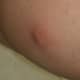 sebaceous-cyst-pictures-symptoms-removal-treatment-causes