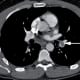 recovering-from-a-pulmonary-embolism