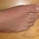 what-to-expect-the-first-time-you-have-gout