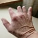Back of right hand affected by symbrachydactyly