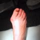 Bunion