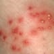 staph-infection