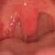 swollen-uvula