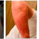 photo: poison-ivy.org Allergic reaction to poison ivy after skin contact on back of legs and Allergic reaction - blisters from contact with poison ivy
