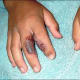 photo: poison-ivy.org "Burns" on fingers from contact with poison ivy (this is very similar to the burns I had on my hands from contact with hellebore sap....but mine were worse!