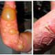 poison-ivy.org Huge blisters on arm from contact with poison ivy and Skin on arm drying out as large blisters subsided
