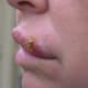 Cold sore on the lips crusting over.