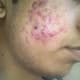 Severe acne on the face, resulting in papules and pustules on the cheeks.
