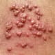 what-does-herpes-look-like-does-herpes-look-like-a-pimple
