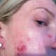 what-does-herpes-look-like-does-herpes-look-like-a-pimple