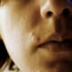 Beginning stages of pimple formation near the mouth.