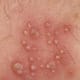 Herpes blisters are clear, white, or yellow and are filled with clear liquid. They lie right on the surface of the skin.