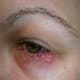 HSV-1 under the eyes.