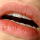 Herpes labialis (oral herpes) on the lips.
