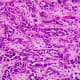 This is what cancer cells look like under a microscope.