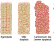 This shows the progression of what happens when cancer develops.