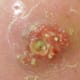 staph-infection