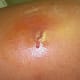 staph-infection
