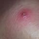 staph-infection