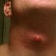 staph-infection
