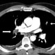 recovering-from-a-pulmonary-embolism