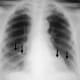 recovering-from-a-pulmonary-embolism