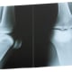 Lupus patients often have joint pain in the knees.