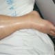 A case of lower leg and foot edema. The skin often stretches and can become shiny, as we can see in this case.