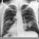 X-ray of cancer.
