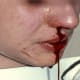 Blood ingested from bleeding in the mouth or nose can lead to a black stool.