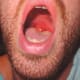 swollen-uvula