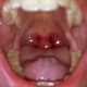 swollen-uvula
