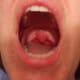 swollen-uvula