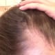 My temples were hit especially hard during the 2 years I experienced heavy hair thinning. They have since filled in and are now normal!