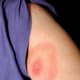 Typical EM rash caused by Lyme disease. Lyme rashes can disappear quickly, so if you don't know what kind of rash it is, it is wise to take a picture to document it for your doctor.