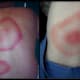 Lyme disease rashes can be as large as your back, or rather small.