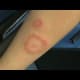 Some ringworm rashes are raised, unlike Lyme rashes, which are flat against the skin.