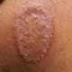 Ringworm rashes are often scaly. Untreated, they may last a month or more. If treated with antifungal cream they can clear up much faster. Some rashes are very scaly and itchy.