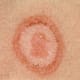It can be tricky to tell the difference between Lyme and ringworm. A doctor can take a skin cell sample and send it to the lab for evaluation.