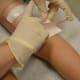 After application, each lesion is covered by a band-aid or sterile cloth.